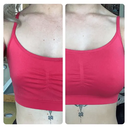 Breast Lift in Turkey